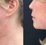 How To Prepare for Your Earlobe Repair Appointment