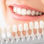 The Truth About Teeth Whitening