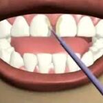 Using Veneers to Close Gaps in Teeth