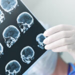 What to Expect for Neurological Surgery