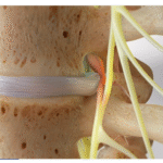 Surgical Options for Herniated Disc
