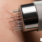 The Benefits of Getting Microneedling