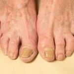 Benefits of Laser Nail Fungal Treatment for Persistent Nail Infections