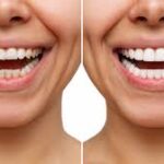 Enhancing Your Smile with Porcelain Veneers
