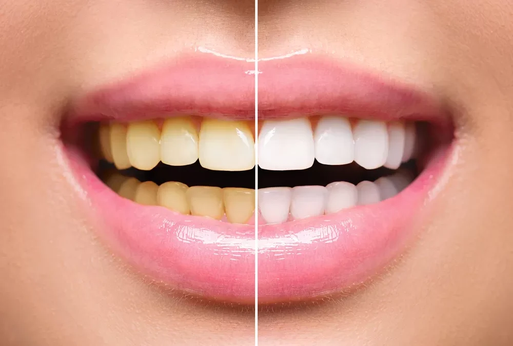 Exploring the Different Methods of Teeth Whitening
