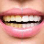 Exploring the Different Methods of Teeth Whitening