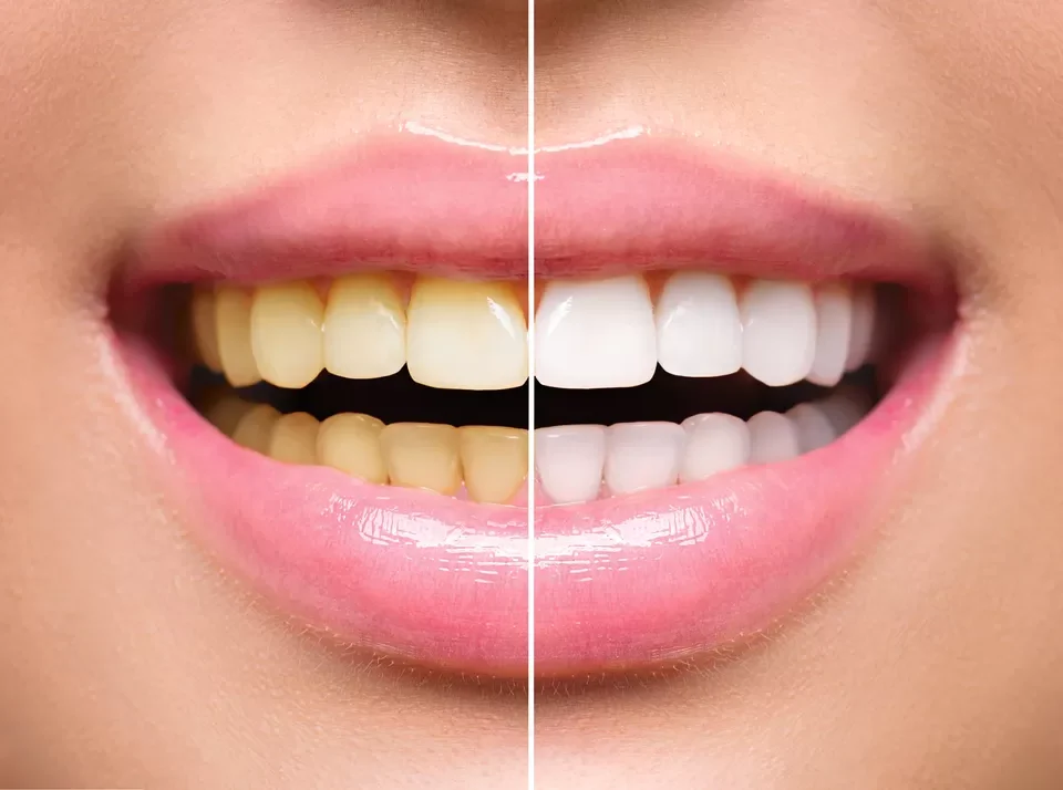 Exploring the Different Methods of Teeth Whitening