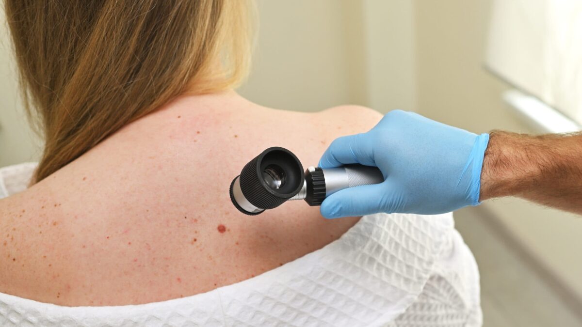 How to Monitor Changes in Skin Cancer Over Time