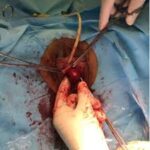 Surgical Approaches to Hernia Repair