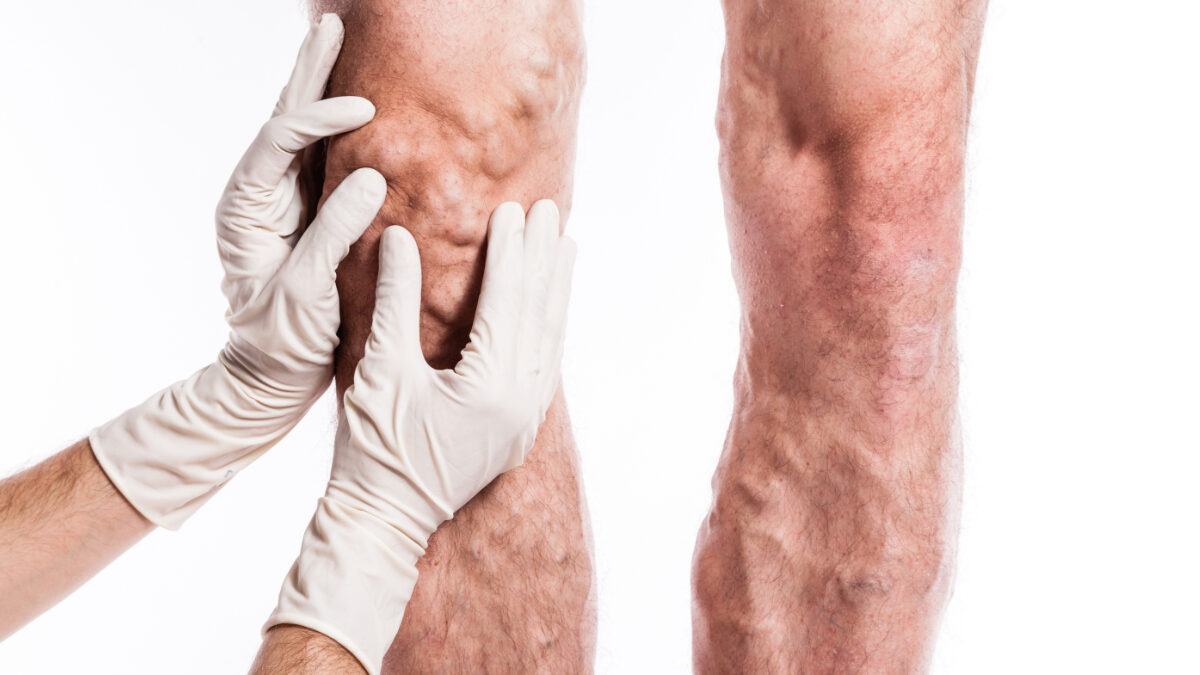 Exploring the Connection Between Vascular Disease and Diabetes