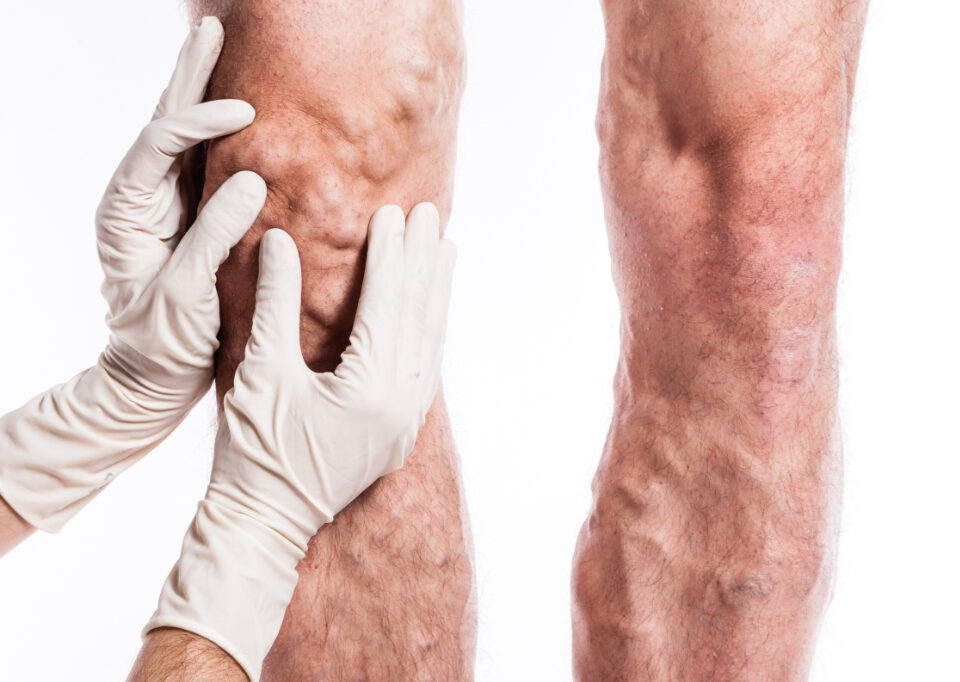 Exploring the Connection Between Vascular Disease and Diabetes