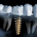 How Endodontic Implants Can Restore Functionality And Aesthetics