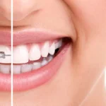 How To Find Affordable Braces Without Compromising Quality