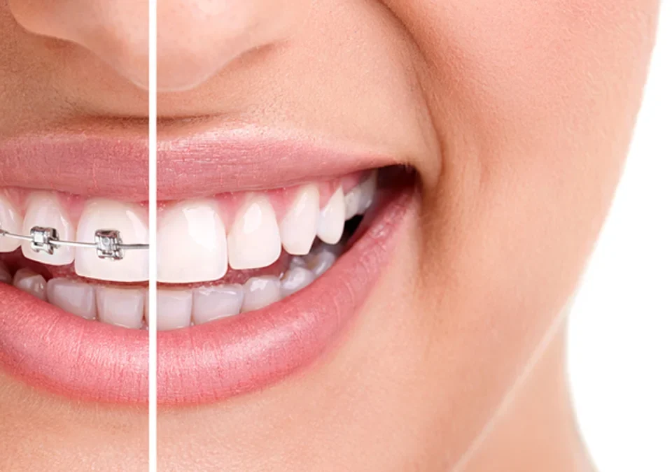 How To Find Affordable Braces Without Compromising Quality