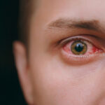 Identifying and Managing Cysts on the Eye