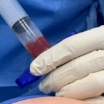 Stem Cell Therapy as an Alternative to Surgery for Back Pain
