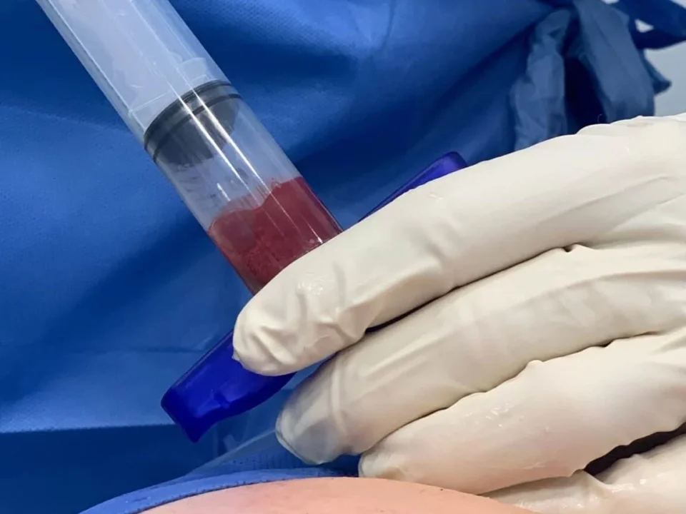Stem Cell Therapy as an Alternative to Surgery for Back Pain