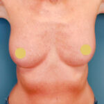 The Role of Consultation in Successful Breast Augmentation