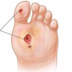 The Role of Education in Successful Diabetic Wound Care