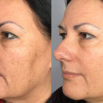 The Science Behind Halo Laser Resurfacing