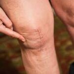 What to Expect from Knee Replacement Surgery